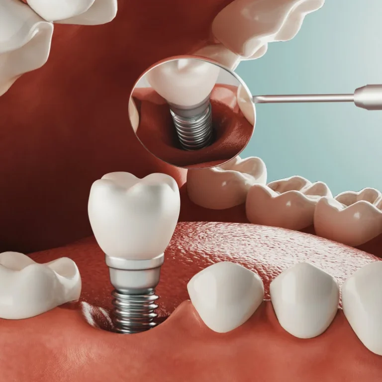 dental-implants