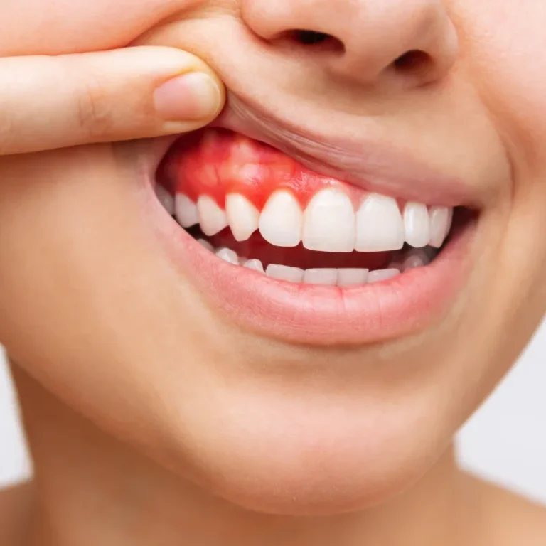 periodontal-diseases